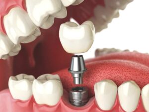 Teljes fogimplantátum és fogkőleszedés