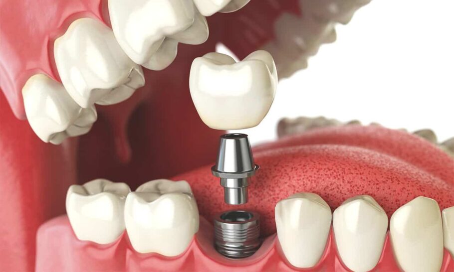 Teljes fogimplantátum és fogkőleszedés